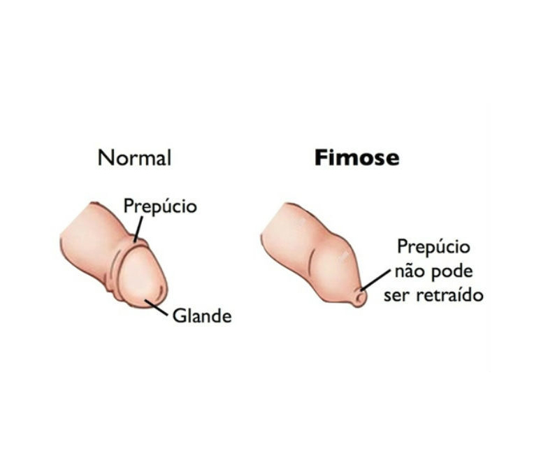 Fimose